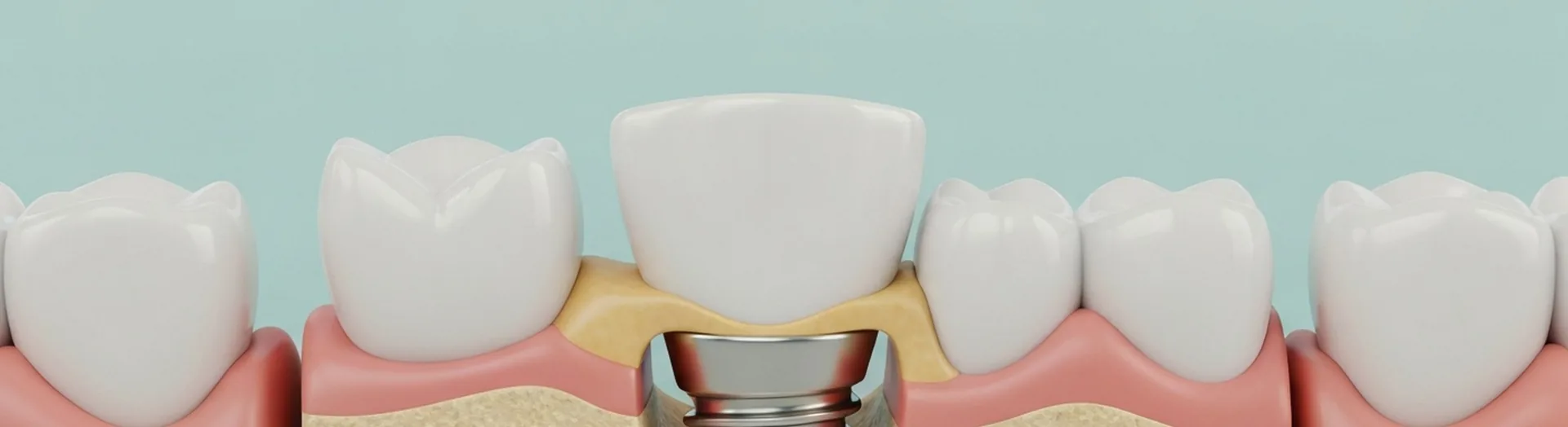 Querschnitt eines Implantats im aufgebauten Kieferknochen